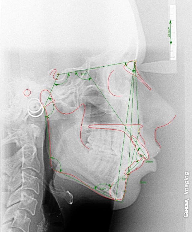 Invisalign Update No. 1: Dr. Reistenhofer Wien | Bikinis & Passports